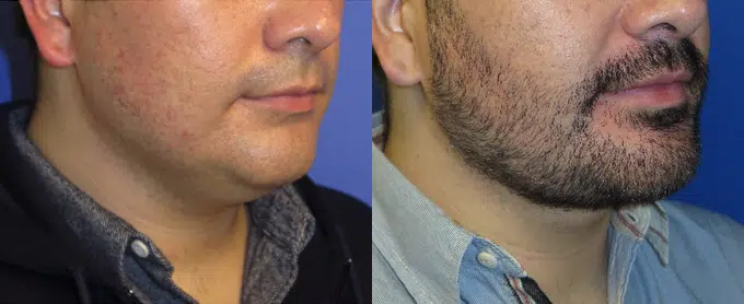 chin liposuction before and after photo by faceology md in newport beach ca