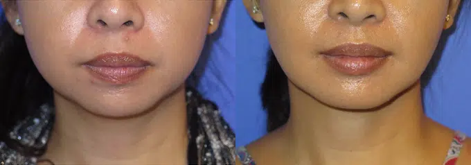 chin liposuction before and after photo by faceology md in newport beach ca
