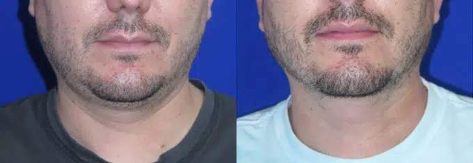 chin liposuction before and after photo by faceology md in newport beach ca