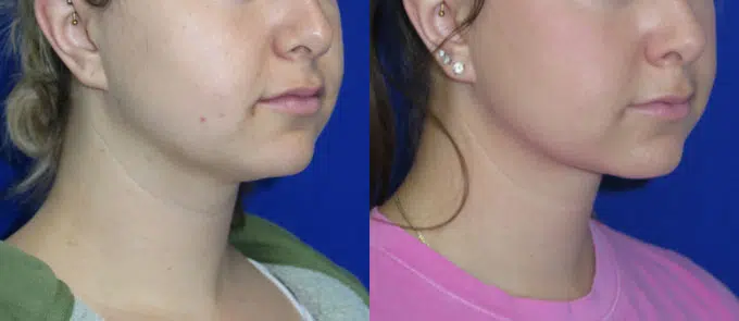 chin liposuction before and after photo by faceology md in newport beach ca