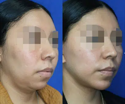 chin liposuction before and after photo by faceology md in newport beach ca