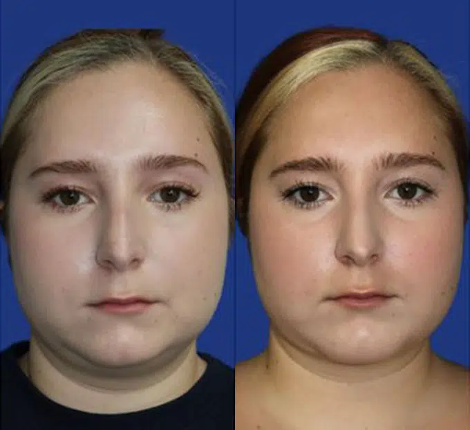 chin liposuction before and after photo by faceology md in newport beach ca