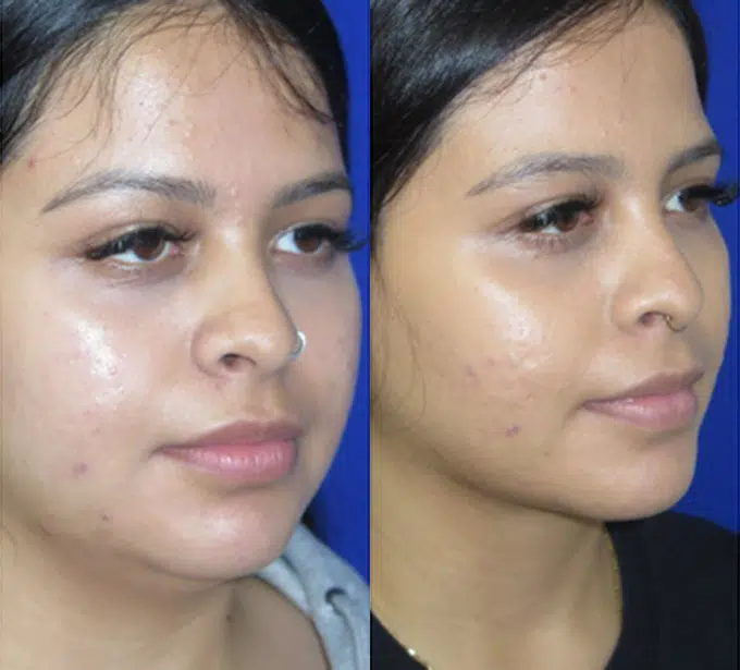 chin liposuction before and after photo by faceology md in newport beach ca