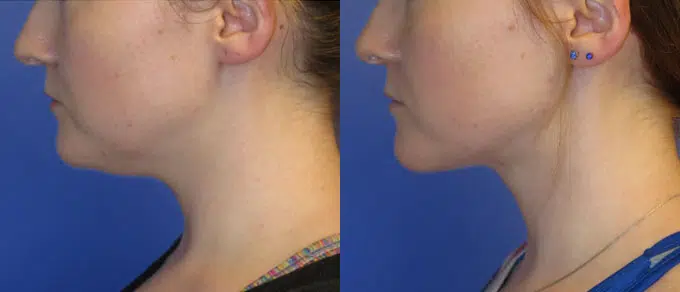 chin liposuction before and after photo by faceology md in newport beach ca