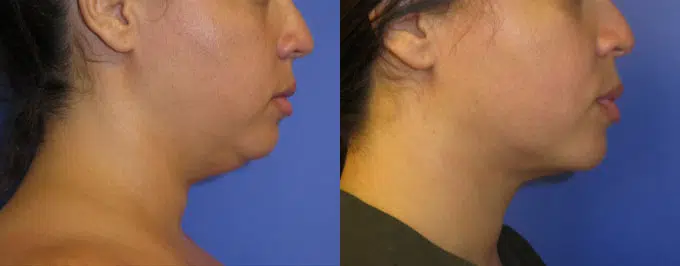chin liposuction before and after photo by faceology md in newport beach ca