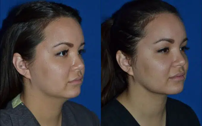chin liposuction before and after photo by faceology md in newport beach ca