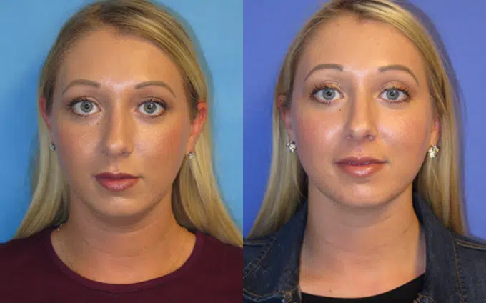 chin liposuction before and after photo by faceology md in newport beach ca