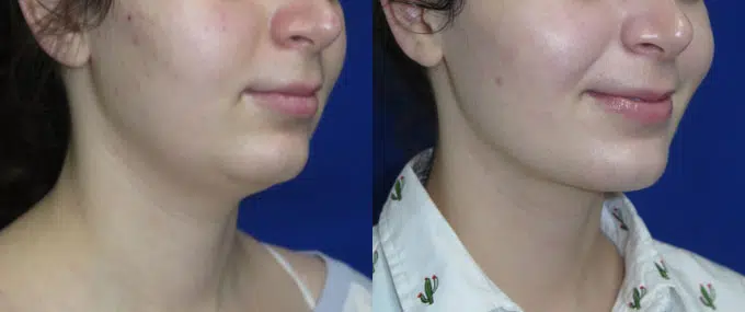 chin liposuction before and after photo by faceology md in newport beach ca
