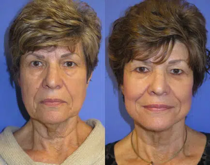 co2 laser before and after photo by faceology md in newport beach ca