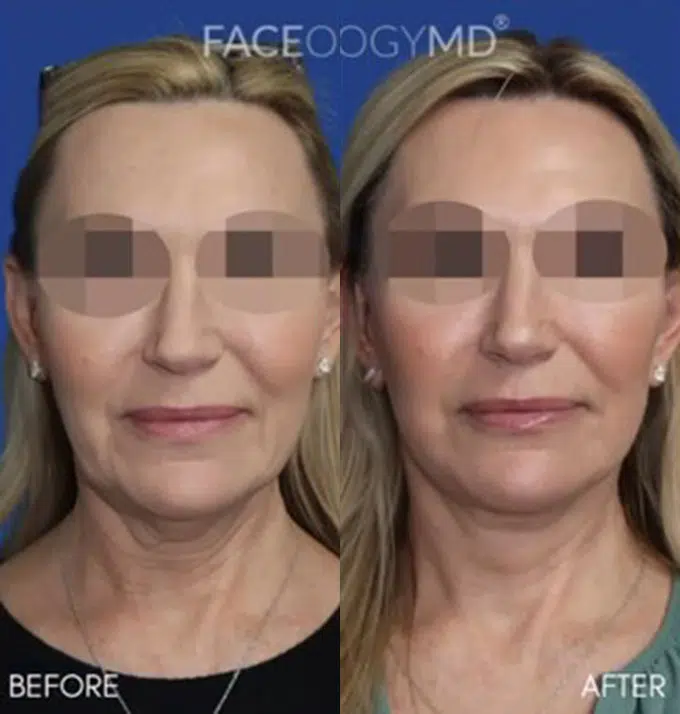 co2 laser before and after photo by faceology md in newport beach ca