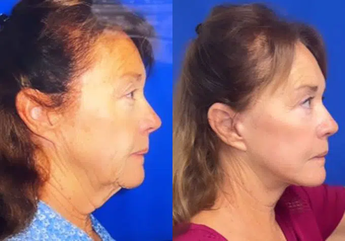 co2 laser before and after photo by faceology md in newport beach ca