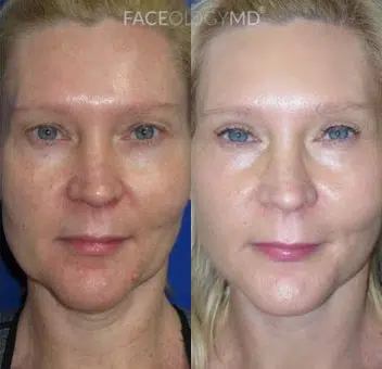 co2 laser before and after photo by faceology md in newport beach ca