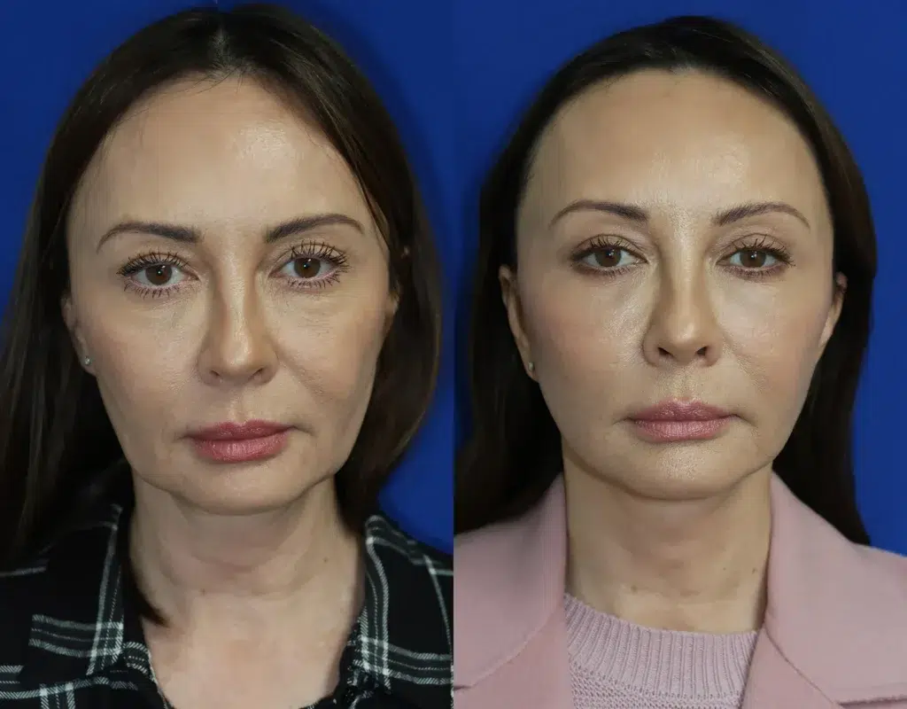 faceology lift neck lift before and after photo by faceology md in newport beach ca