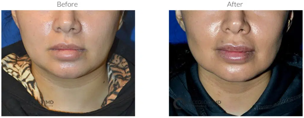 before and after buccal fat slimming faceology md