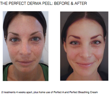 perfect derma peel before and after