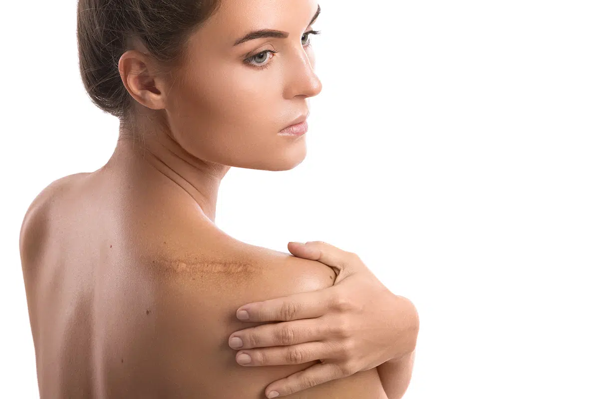 woman with a scar on her shoulder