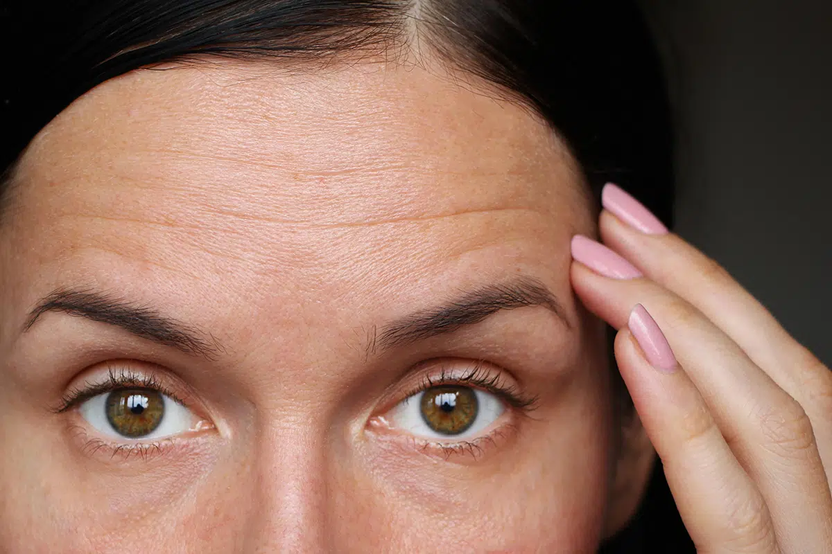 wrinkles on the forehead