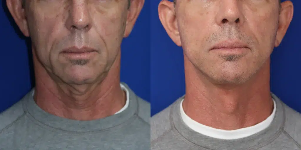 faceology lift neck lift before and after photo by faceology md in newport beach ca