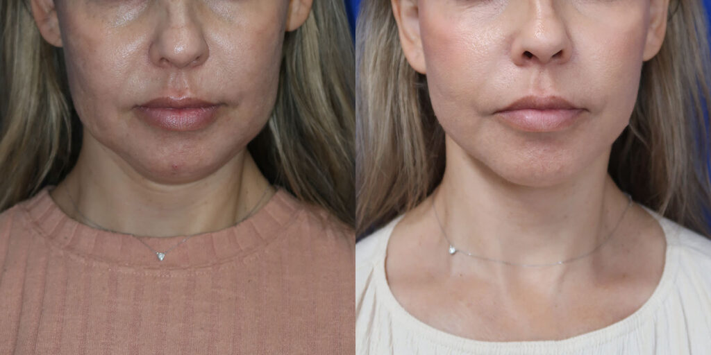 faceology lift neck lift before and after photo by faceology md in newport beach ca