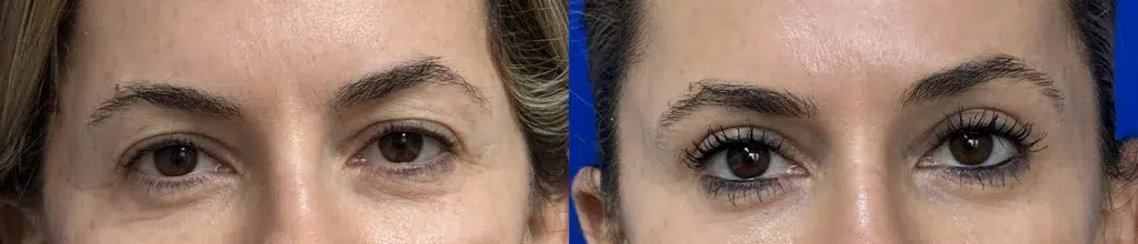 blepharoplasty before and after photo by faceology md in newport beach ca