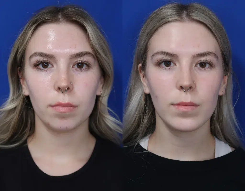 chin augmentation before and after photo by faceology md in newport beach ca