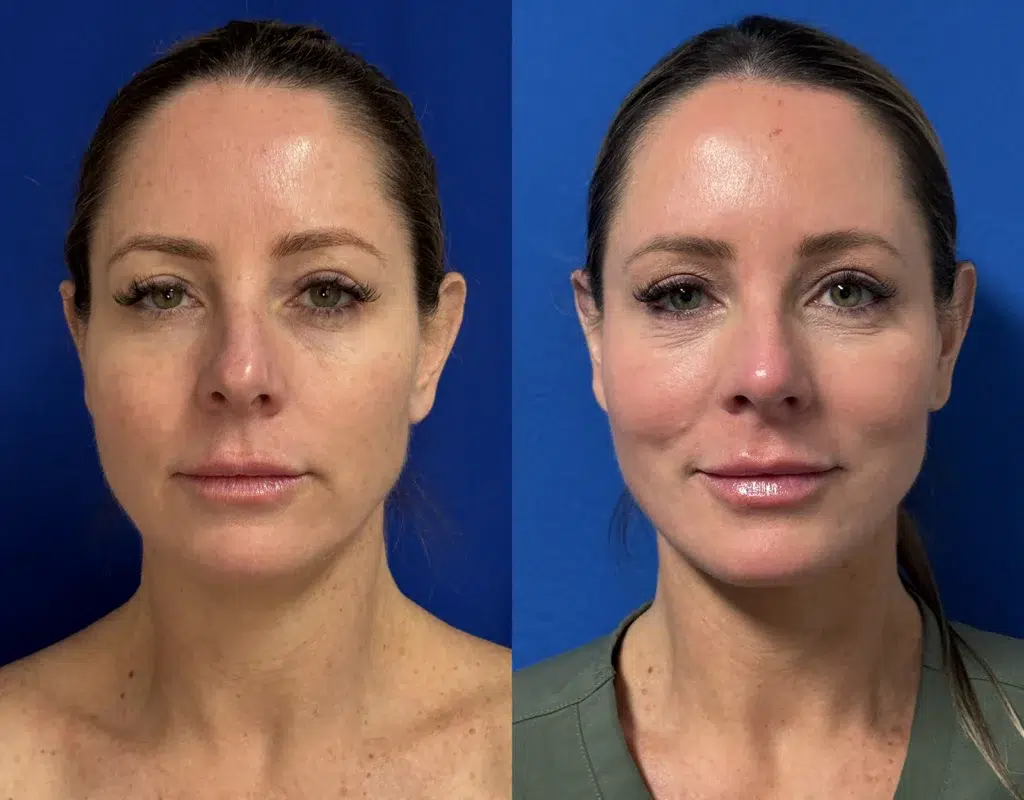 co2 laser before and after photo by faceology md in newport beach ca