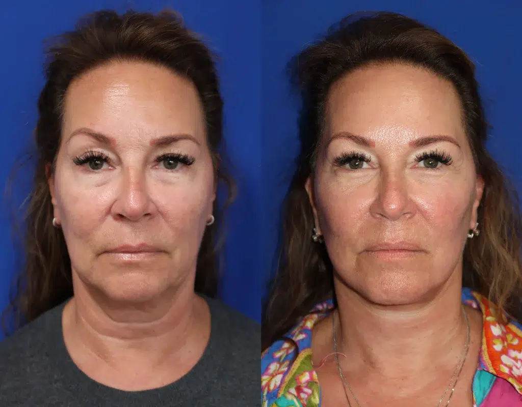 faceology lift neck lift before and after photo by faceology md in newport beach ca