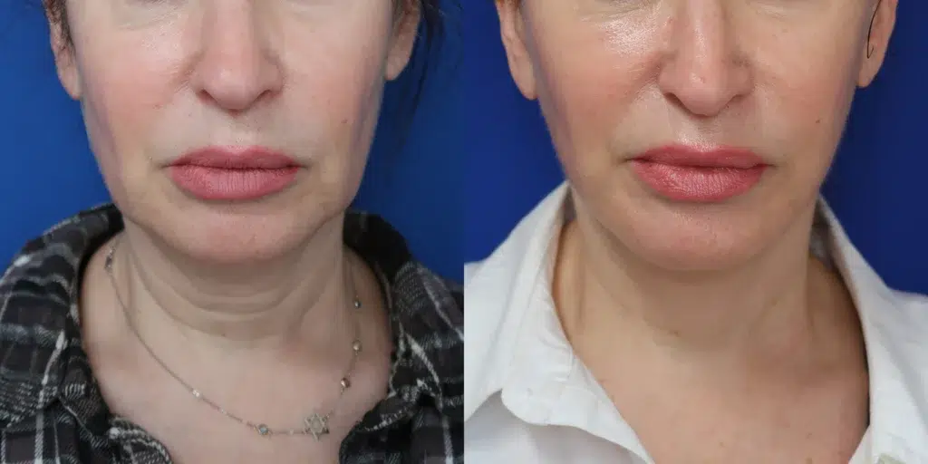 faceology lift neck lift before and after photo by faceology md in newport beach ca