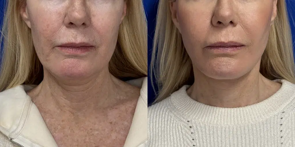 faceology lift neck lift before and after photo by faceology md in newport beach ca