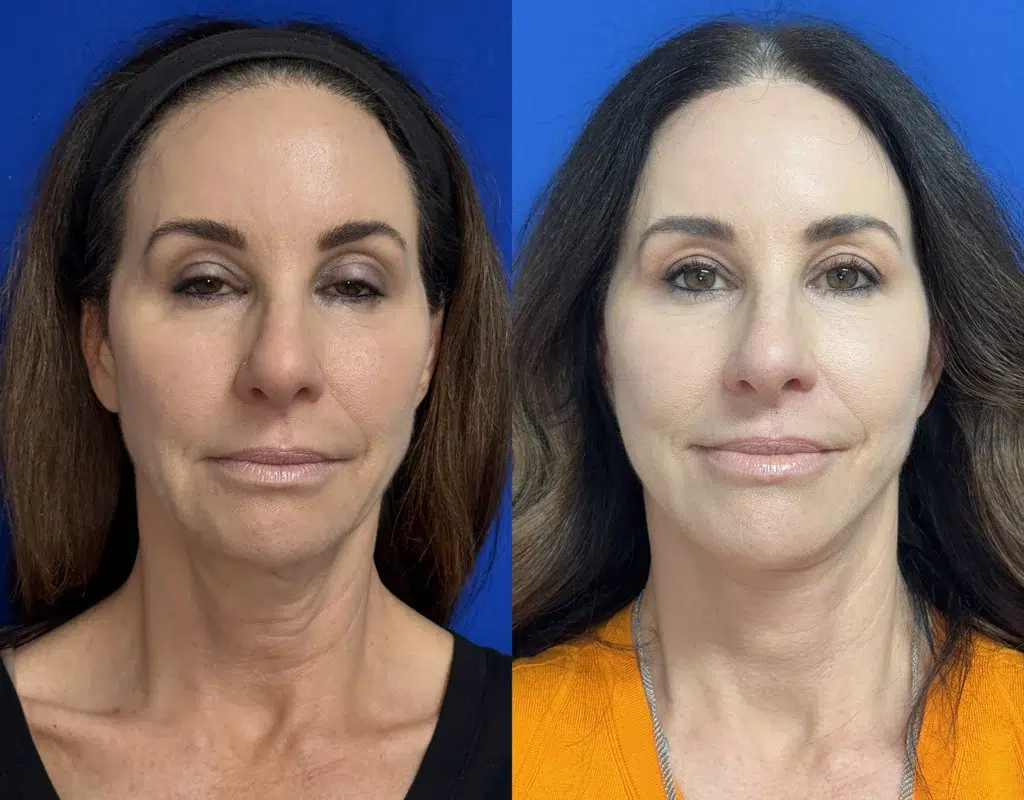 faceology lift neck lift before and after photo by faceology md in newport beach ca