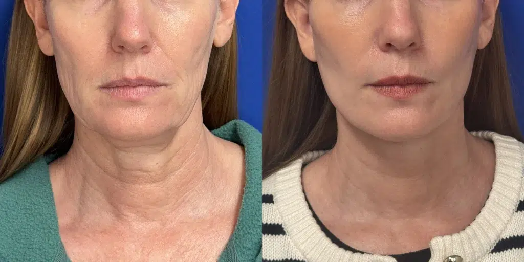 faceology lift neck lift before and after photo by faceology md in newport beach ca