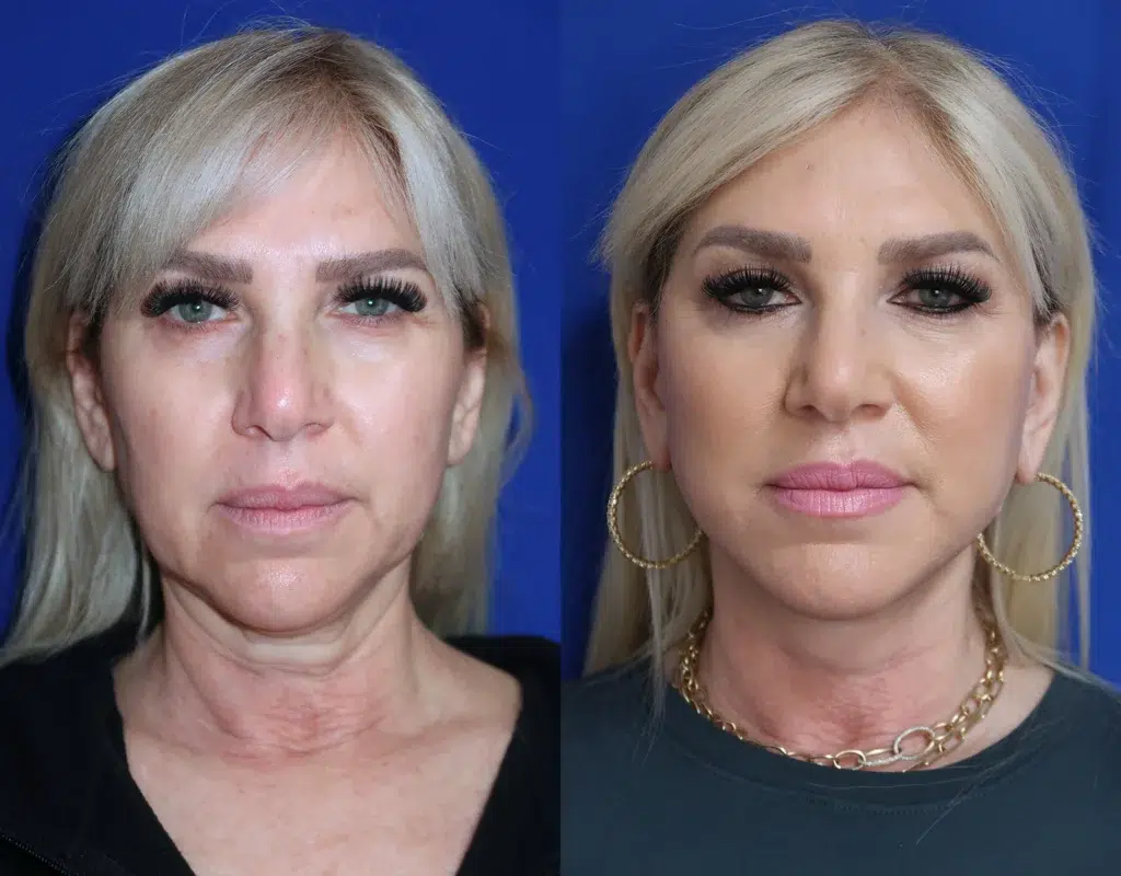 faceology lift neck lift before and after photo by faceology md in newport beach ca
