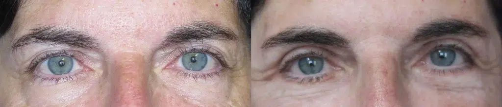 blepharoplasty before and after photo by faceology md in newport beach ca