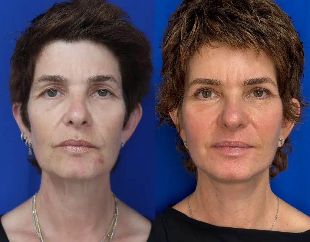 faceology lift neck lift before and after photo by faceology md in newport beach ca
