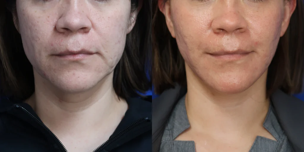 faceology lift neck lift before and after photo by faceology md in newport beach ca