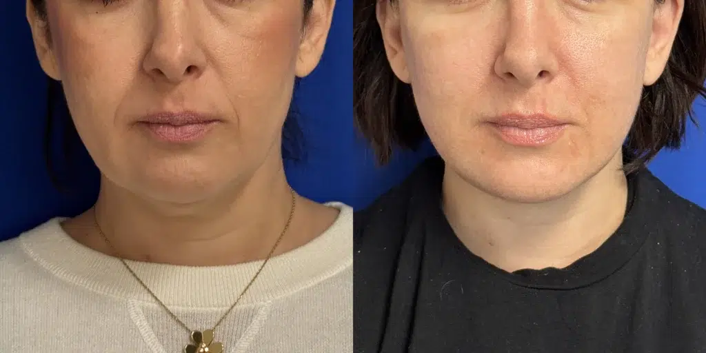 faceology lift neck lift with co2 laser before and after photo by faceology md in newport beach ca