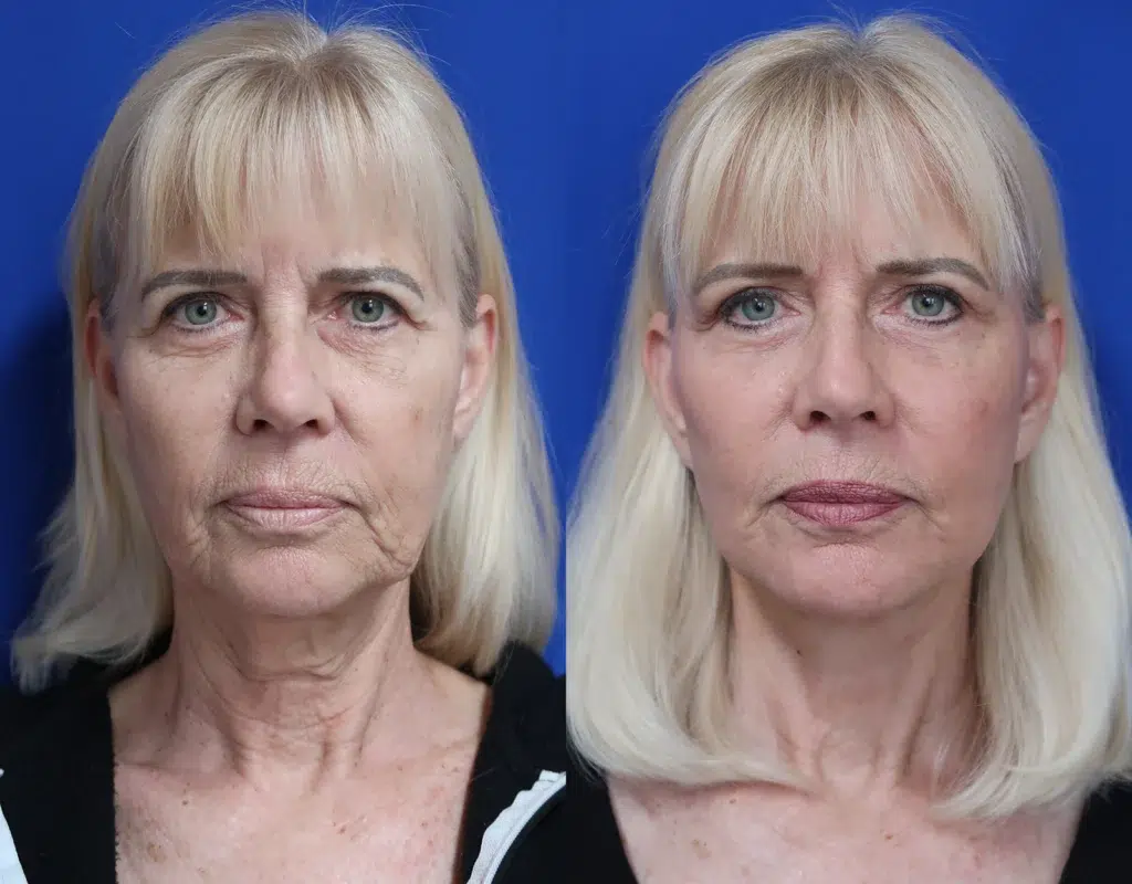 faceology lift neck lift brow lift with co laser before and after photo by faceology md in newport beach ca