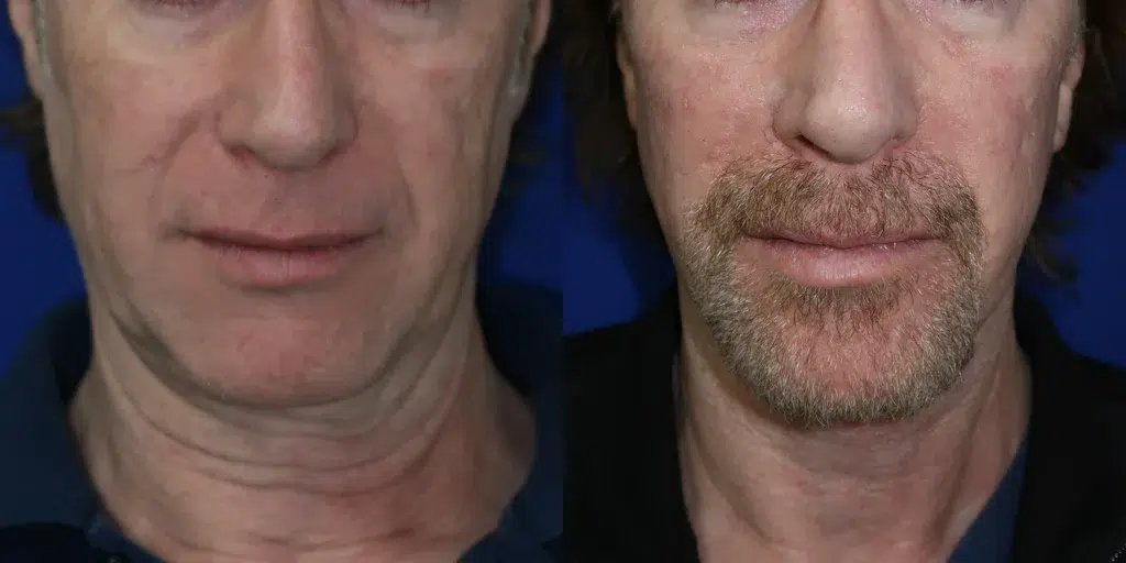 faceology lift neck lift before and after photo by faceology md in newport beach ca