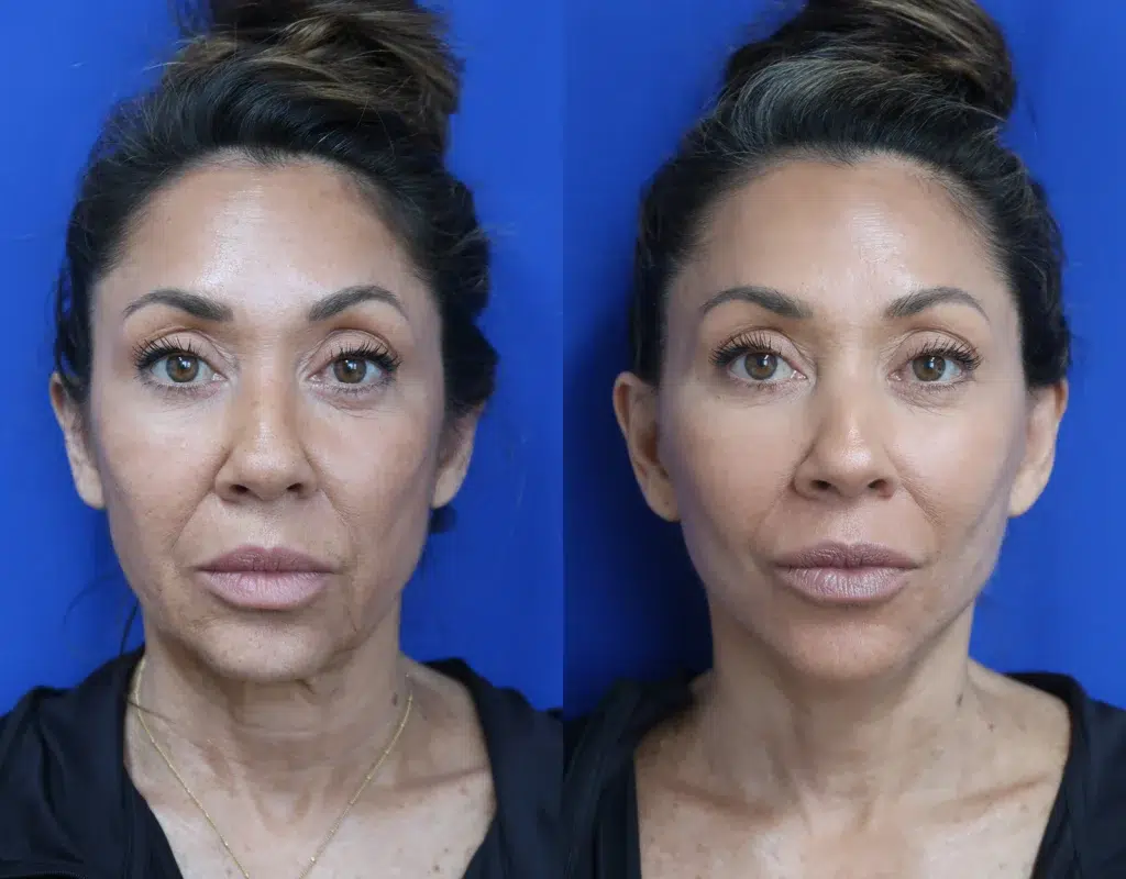 faceology lift neck lift before and after photo by faceology md in newport beach ca