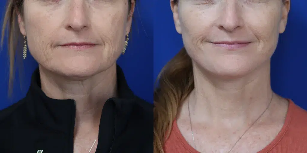 faceology lift neck lift before and after photo by faceology md in newport beach ca