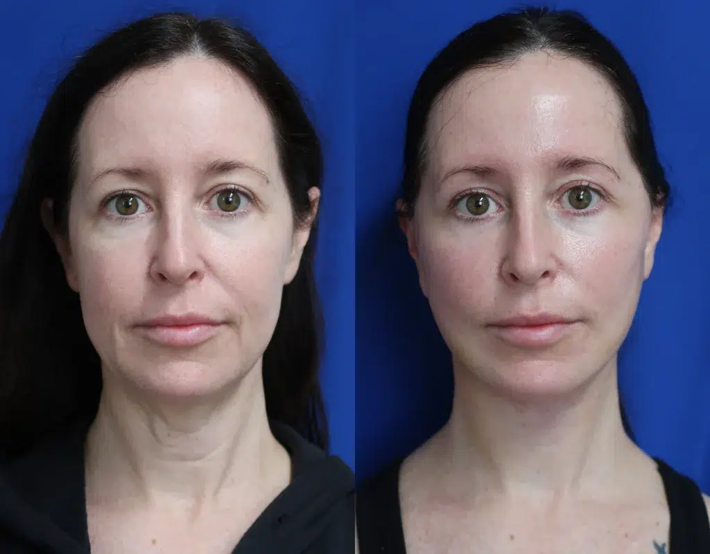 faceology lift neck lift before and after photo by faceology md in newport beach ca