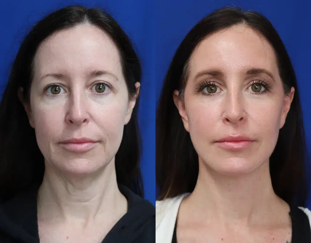 faceology lift neck lift before and after photo by faceology md in newport beach ca