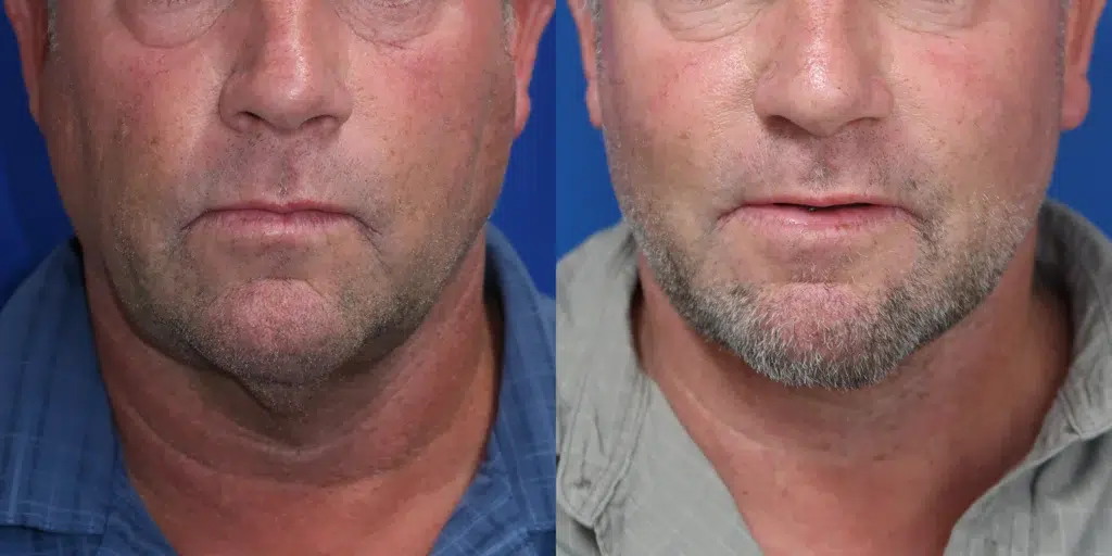 faceology lift neck lift before and after photo by faceology md in newport beach ca