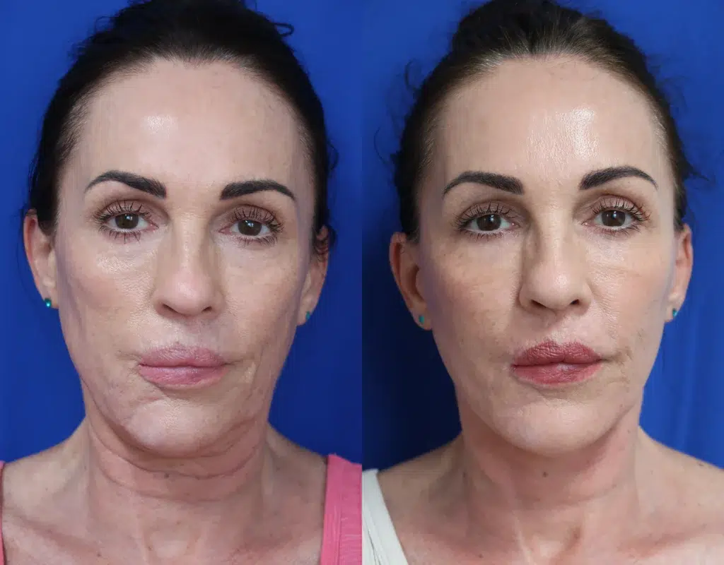 faceology lift neck lift before and after photo by faceology md in newport beach ca