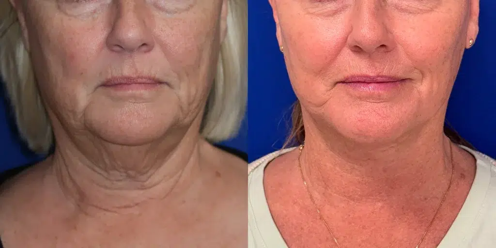faceology lift neck lift with co laser before and after photo by faceology md in newport beach ca