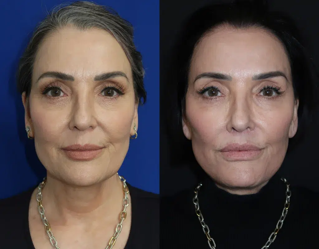 mini facelift and lip augmentation before and after photo by faceology md in newport beach ca