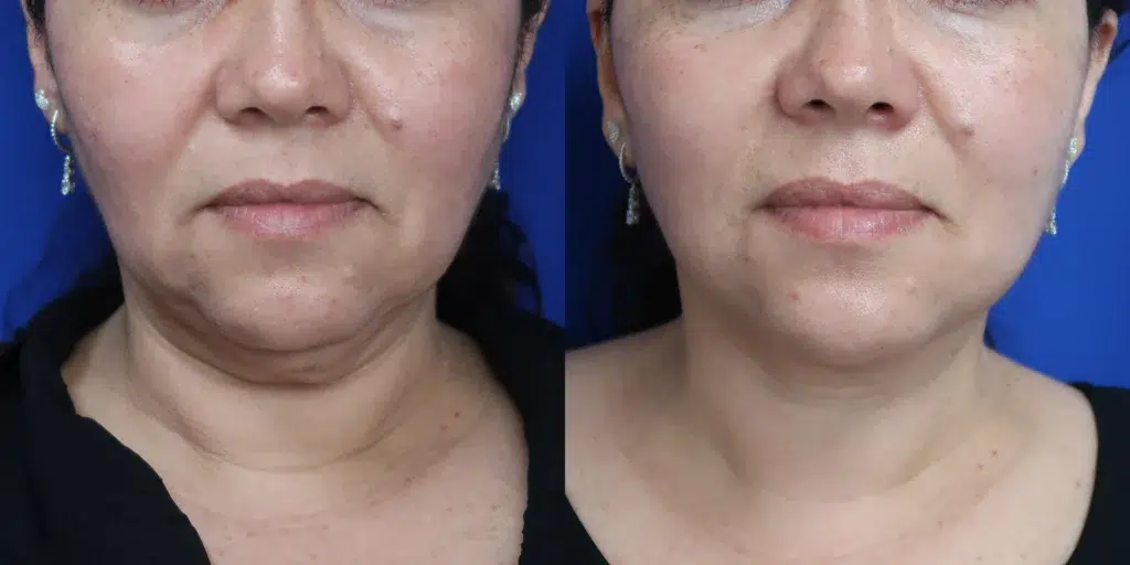 faceology lift neck lift before and after photo by faceology md in newport beach ca