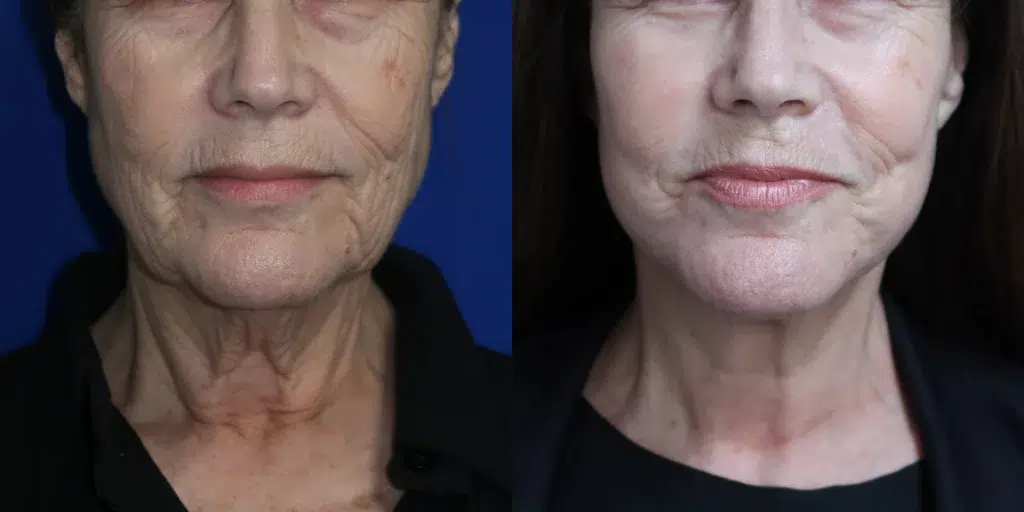faceology lift neck lift before and after photo by faceology md in newport beach ca
