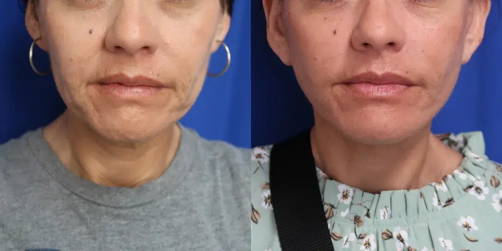 faceology lift neck lift before and after photo by faceology md in newport beach ca