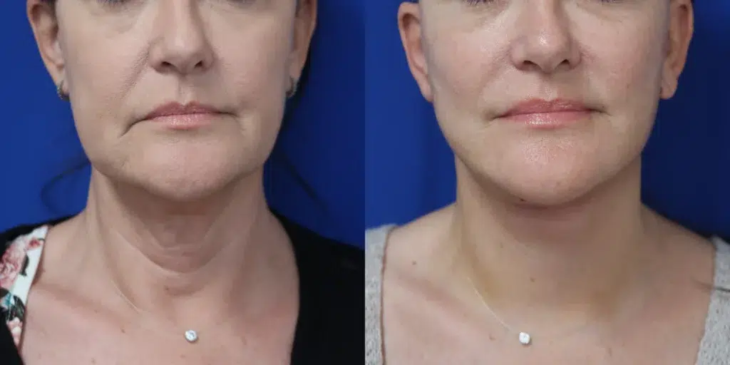 faceology lift neck lift before and after photo by faceology md in newport beach ca